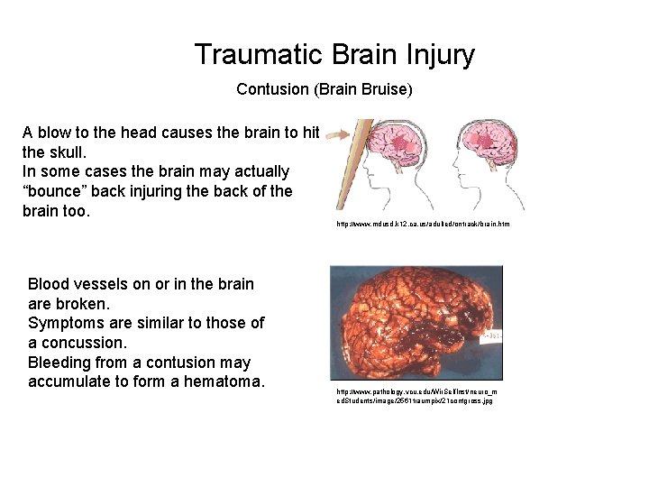 Traumatic Brain Injury Contusion (Brain Bruise) A blow to the head causes the brain