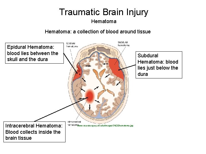 Traumatic Brain Injury Hematoma: a collection of blood around tissue Epidural Hematoma: blood lies