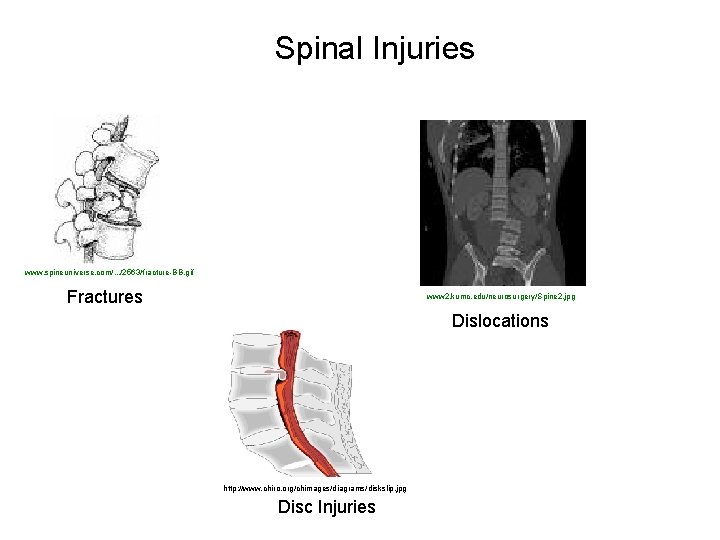 Spinal Injuries www. spineuniverse. com/. . . /2563/fracture-BB. gif Fractures www 2. kumc. edu/neurosurgery/Spine