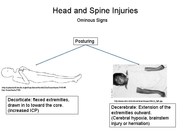 Head and Spine Injuries Ominous Signs Posturing http: //upload. wikimedia. org/wikipedia/en/thumb/2/2 a/Decorticate. PNG/45 0