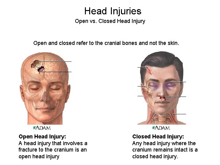 Head Injuries Open vs. Closed Head Injury Open and closed refer to the cranial
