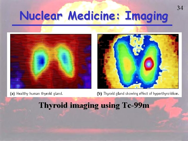 Nuclear Medicine: Imaging Thyroid imaging using Tc-99 m 34 