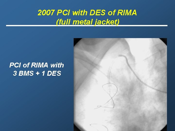 2007 PCI with DES of RIMA (full metal jacket) PCI of RIMA with 3