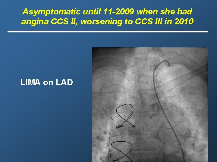 Asymptomatic until 11 -2009 when she had angina CCS II, worsening to CCS III