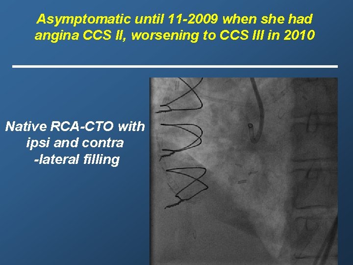 Asymptomatic until 11 -2009 when she had angina CCS II, worsening to CCS III