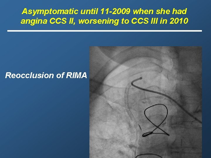 Asymptomatic until 11 -2009 when she had angina CCS II, worsening to CCS III