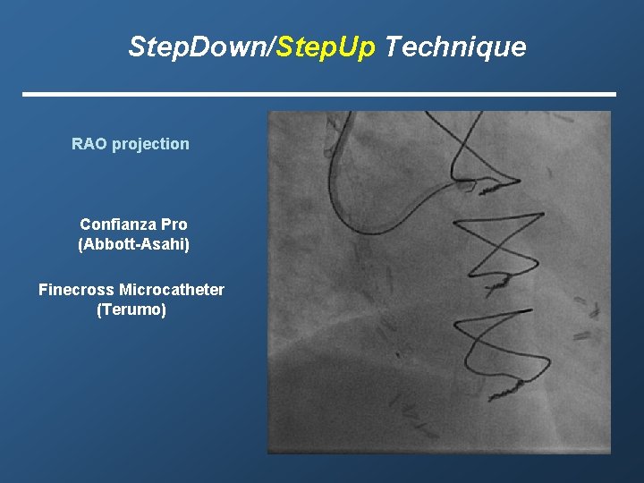 Step. Down/Step. Up Technique RAO projection Confianza Pro (Abbott-Asahi) Finecross Microcatheter (Terumo) 