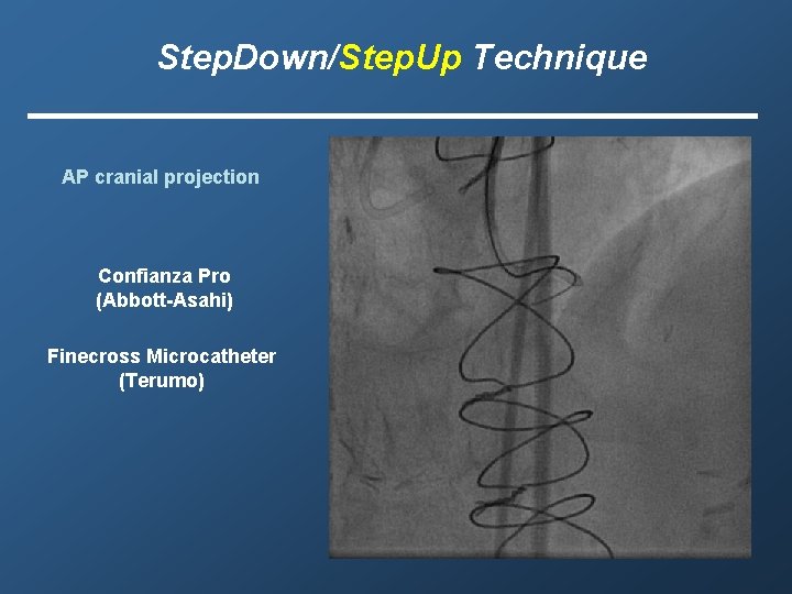 Step. Down/Step. Up Technique AP cranial projection Confianza Pro (Abbott-Asahi) Finecross Microcatheter (Terumo) 