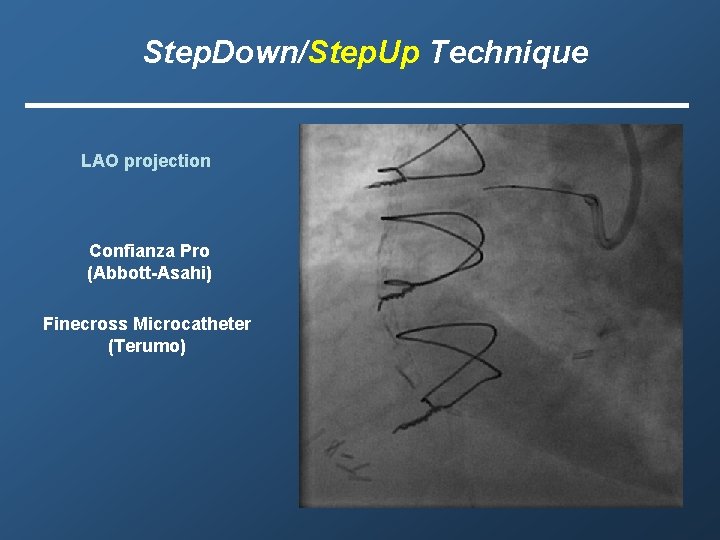 Step. Down/Step. Up Technique LAO projection Confianza Pro (Abbott-Asahi) Finecross Microcatheter (Terumo) 