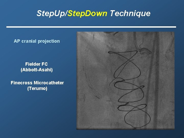 Step. Up/Step. Down Technique AP cranial projection Fielder FC (Abbott-Asahi) Finecross Microcatheter (Terumo) 