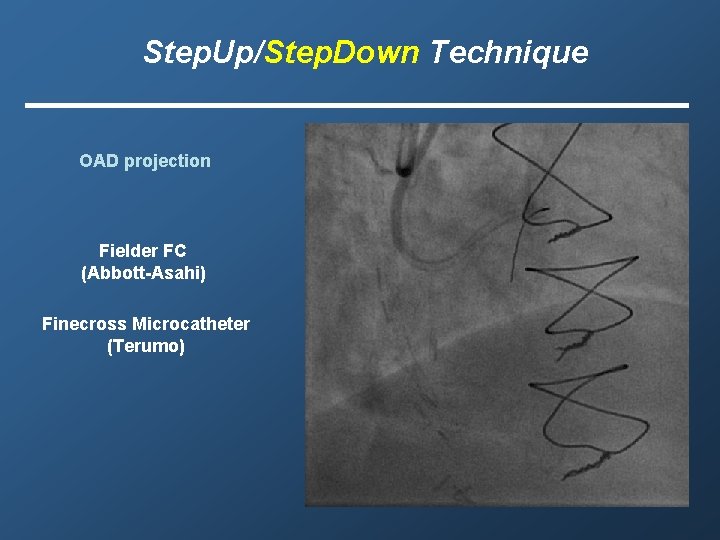 Step. Up/Step. Down Technique OAD projection Fielder FC (Abbott-Asahi) Finecross Microcatheter (Terumo) 
