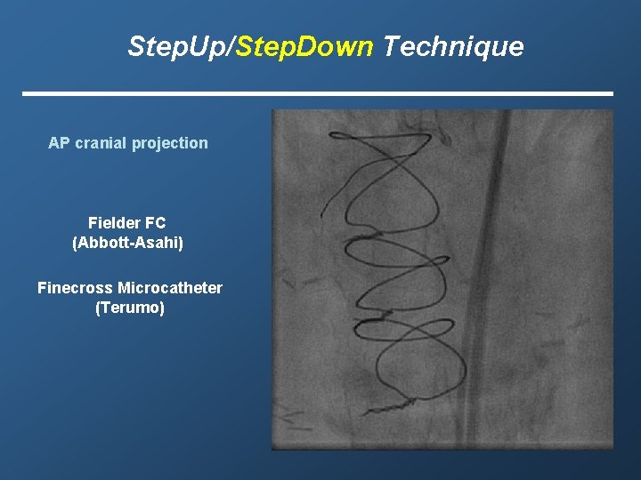 Step. Up/Step. Down Technique AP cranial projection Fielder FC (Abbott-Asahi) Finecross Microcatheter (Terumo) 
