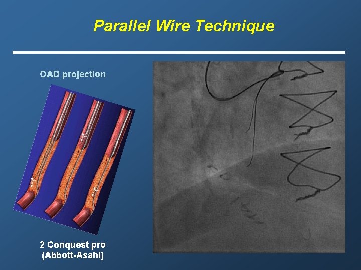 Parallel Wire Technique OAD projection 2 Conquest pro (Abbott-Asahi) 