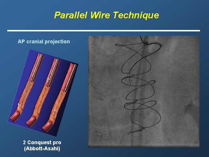 Parallel Wire Technique AP cranial projection 2 Conquest pro (Abbott-Asahi) 