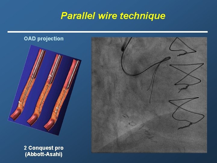 Parallel wire technique OAD projection 2 Conquest pro (Abbott-Asahi) 