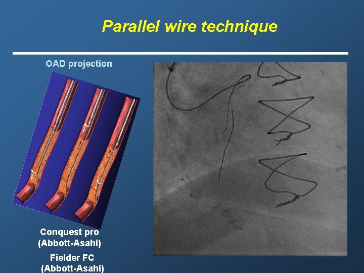 Parallel wire technique OAD projection Conquest pro (Abbott-Asahi) Fielder FC (Abbott-Asahi) 