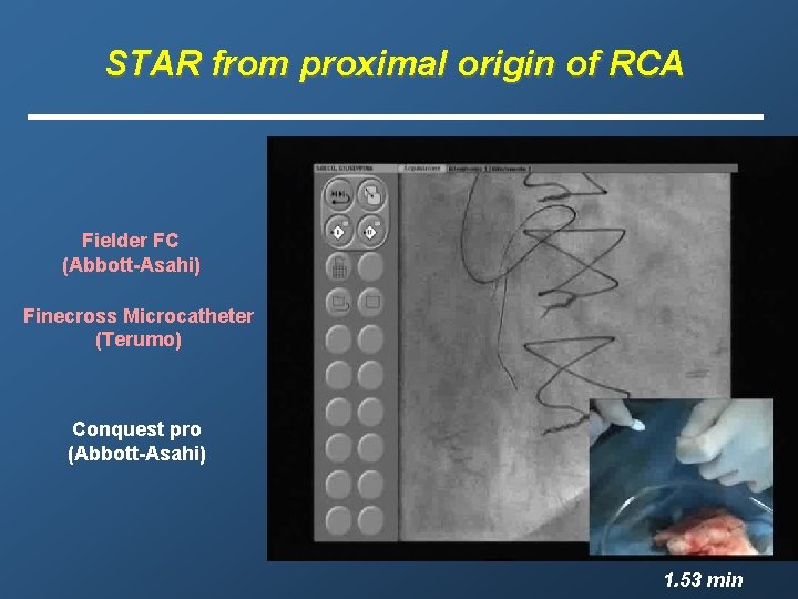 STAR from proximal origin of RCA Fielder FC (Abbott-Asahi) Finecross Microcatheter (Terumo) Conquest pro