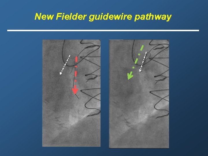 New Fielder guidewire pathway 