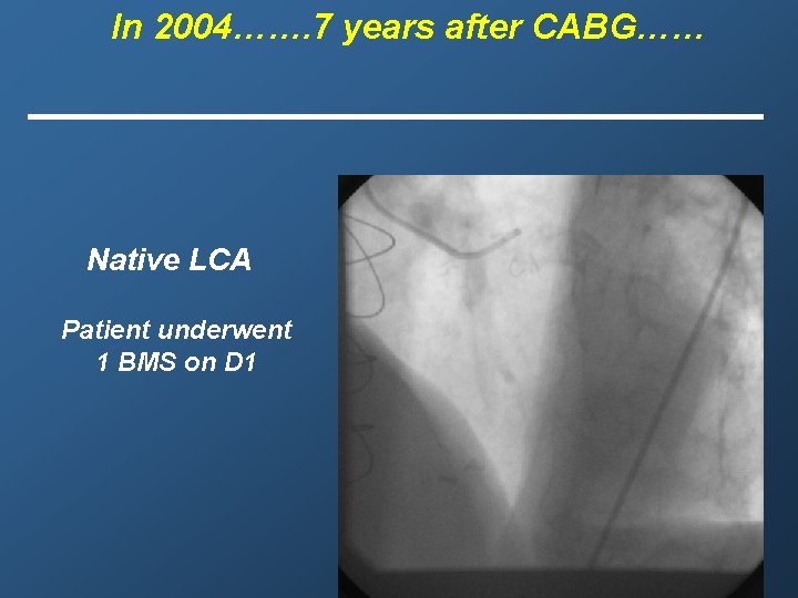 In 2004……. 7 years after CABG…… Native LCA Patient underwent 1 BMS on D