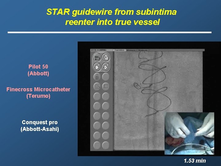 STAR guidewire from subintima reenter into true vessel Pilot 50 (Abbott) Finecross Microcatheter (Terumo)