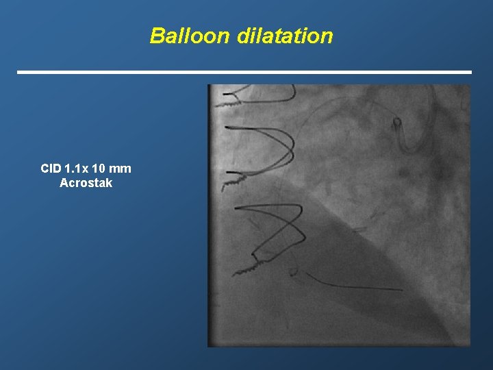 Balloon dilatation CID 1. 1 x 10 mm Acrostak 