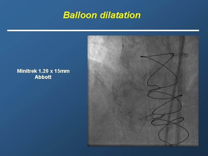 Balloon dilatation Minitrek 1. 20 x 15 mm Abbott 