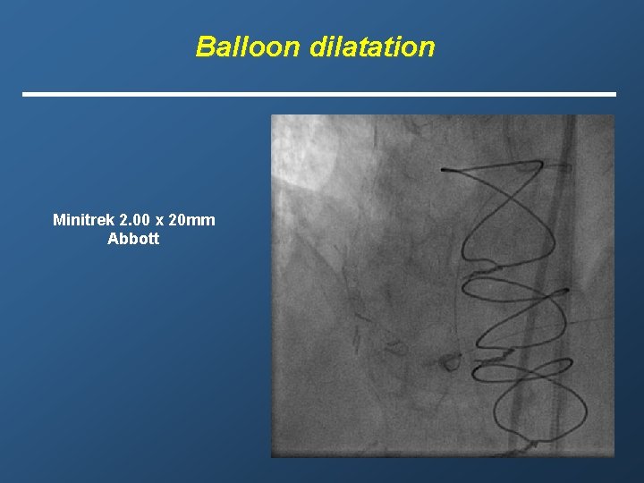 Balloon dilatation Minitrek 2. 00 x 20 mm Abbott 