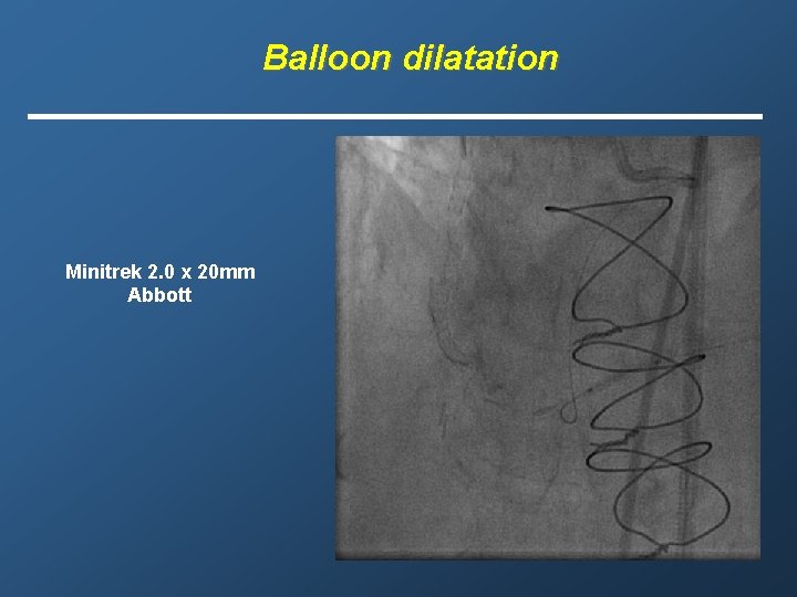 Balloon dilatation Minitrek 2. 0 x 20 mm Abbott 