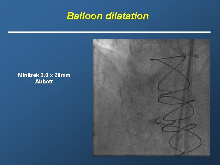 Balloon dilatation Minitrek 2. 0 x 20 mm Abbott 