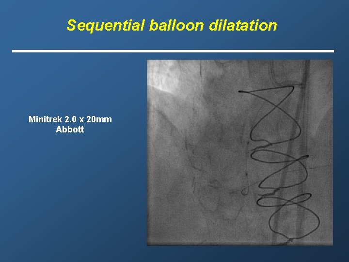 Sequential balloon dilatation Minitrek 2. 0 x 20 mm Abbott 
