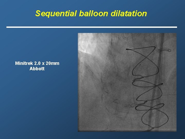 Sequential balloon dilatation Minitrek 2. 0 x 20 mm Abbott 
