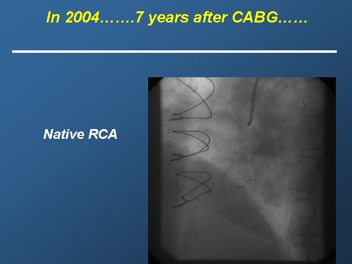 In 2004……. 7 years after CABG…… Native RCA 