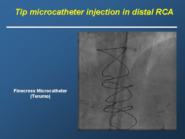 Tip microcatheter injection in distal RCA Finecross Microcatheter (Terumo) 