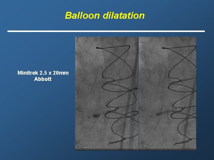 Balloon dilatation Minitrek 2. 5 x 20 mm Abbott 