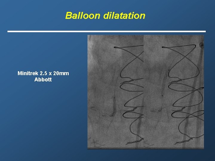 Balloon dilatation Minitrek 2. 5 x 20 mm Abbott 