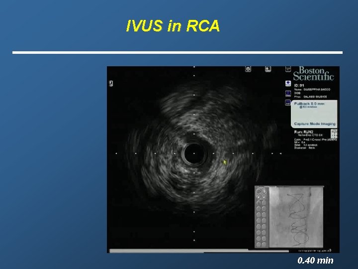 IVUS in RCA 0. 40 min 