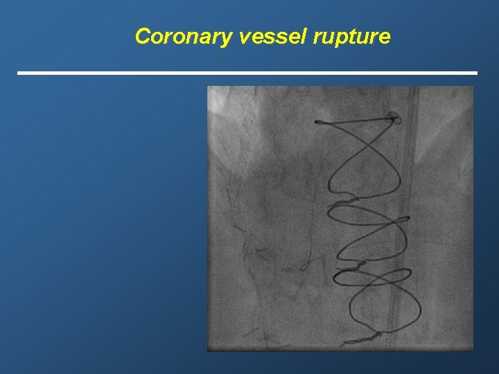 Coronary vessel rupture 