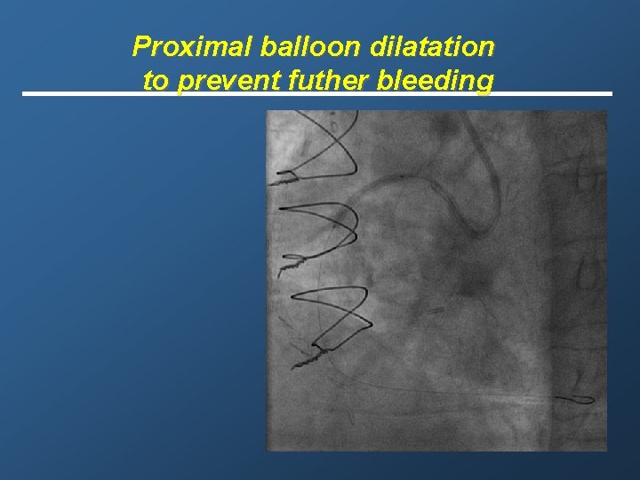 Proximal balloon dilatation to prevent futher bleeding 