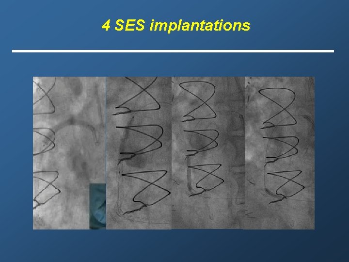 4 SES implantations 