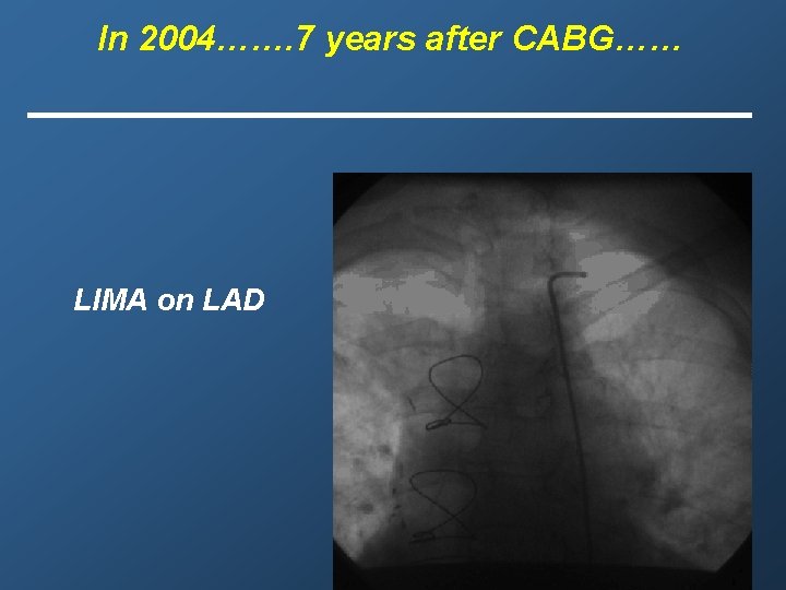In 2004……. 7 years after CABG…… LIMA on LAD 