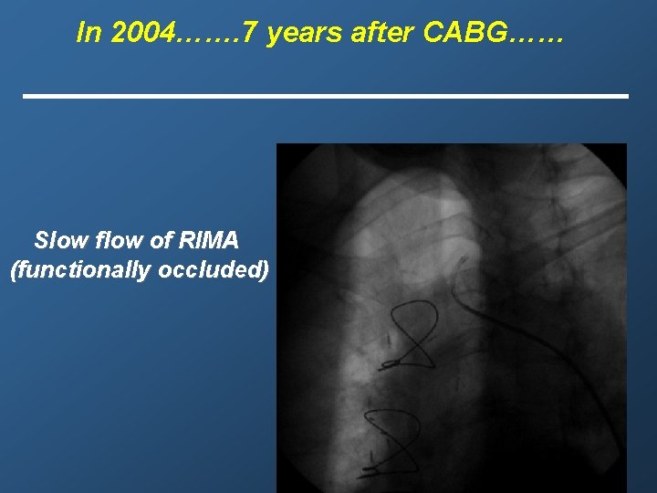 In 2004……. 7 years after CABG…… Slow flow of RIMA (functionally occluded) 