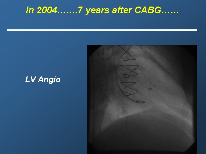 In 2004……. 7 years after CABG…… LV Angio 