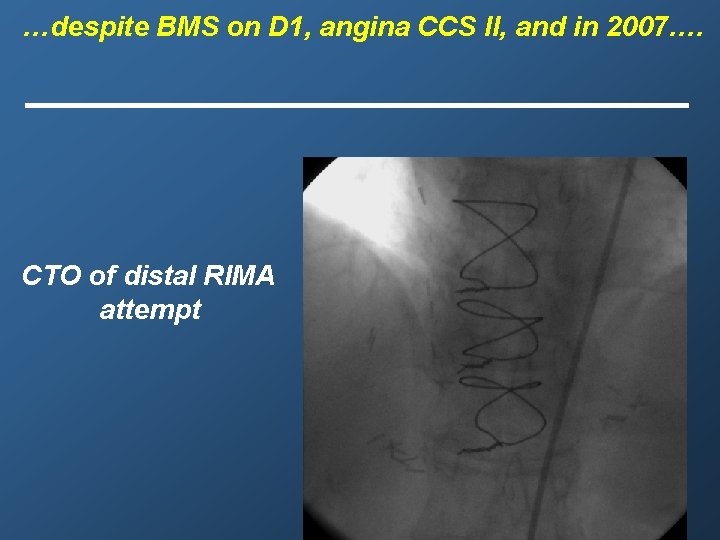 …despite BMS on D 1, angina CCS II, and in 2007…. CTO of distal