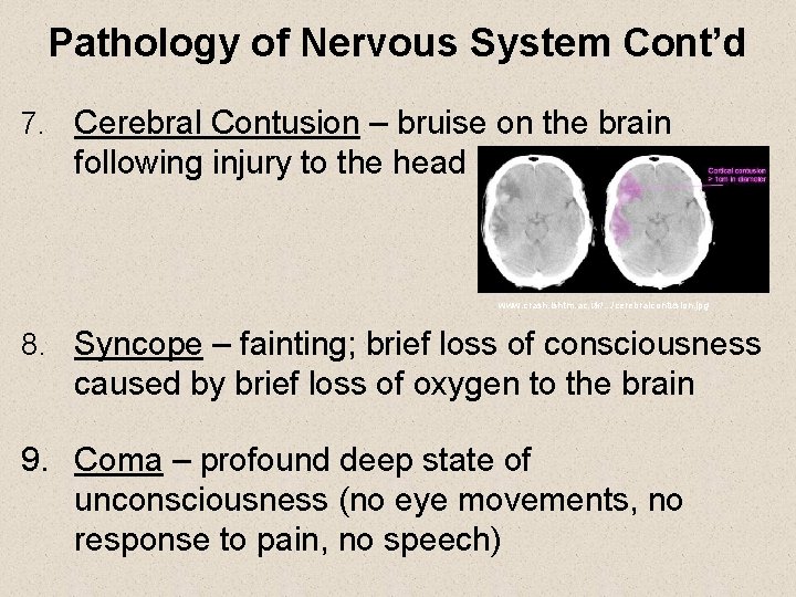 Pathology of Nervous System Cont’d 7. Cerebral Contusion – bruise on the brain following