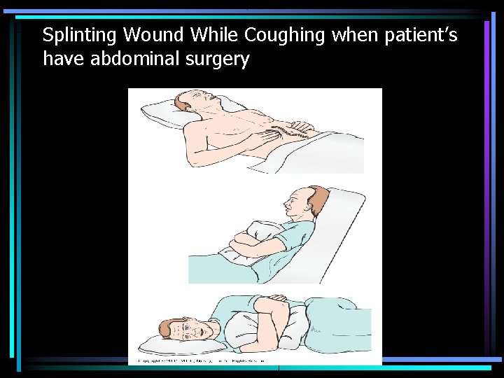 Splinting Wound While Coughing when patient’s have abdominal surgery 