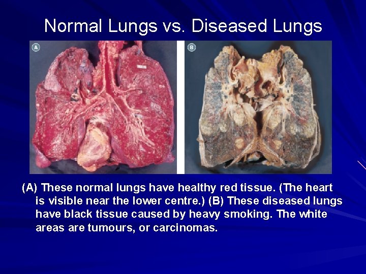Normal Lungs vs. Diseased Lungs (A) These normal lungs have healthy red tissue. (The Normal Lungs vs. Diseased Lungs (A) These normal lungs have healthy red tissue. (The