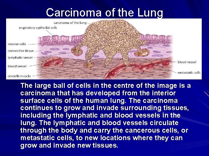 Carcinoma of the Lung The large ball of cells in the centre of the Carcinoma of the Lung The large ball of cells in the centre of the