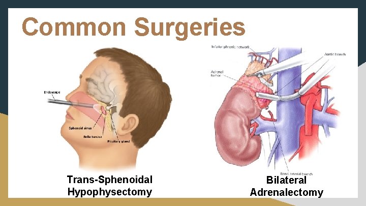 Common Surgeries Trans-Sphenoidal Hypophysectomy Bilateral Adrenalectomy 