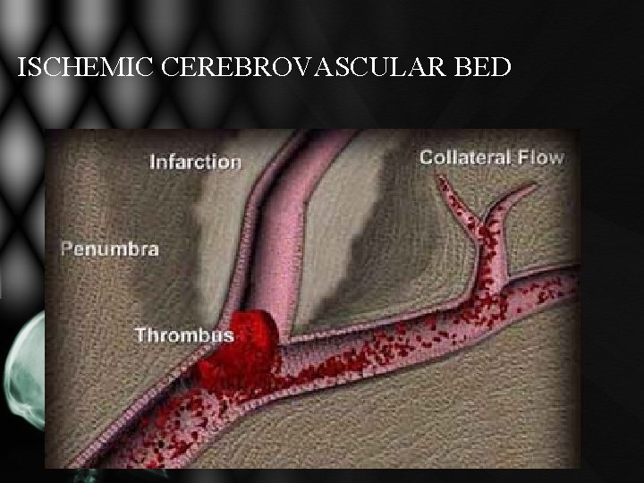 ISCHEMIC CEREBROVASCULAR BED ISCHEMIC CEREBROVASCULAR BED
