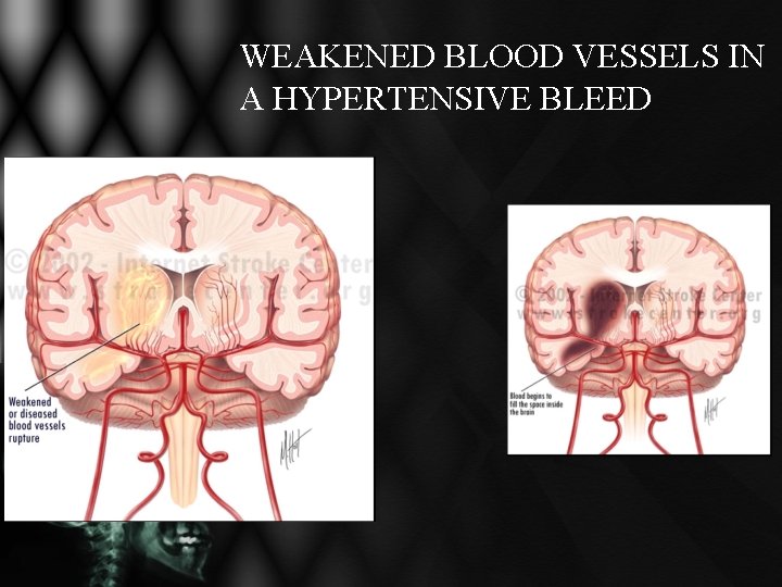 WEAKENED BLOOD VESSELS IN A HYPERTENSIVE BLEED WEAKENED BLOOD VESSELS IN A HYPERTENSIVE BLEED